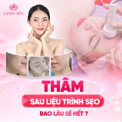 Trị mụn tại thanh hóa