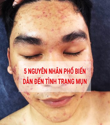 nguyên nhân gây ra mụn