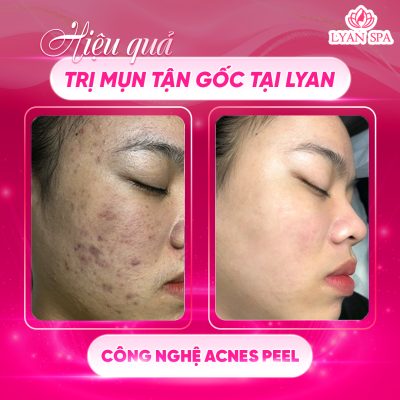 trị mụn tận gốc